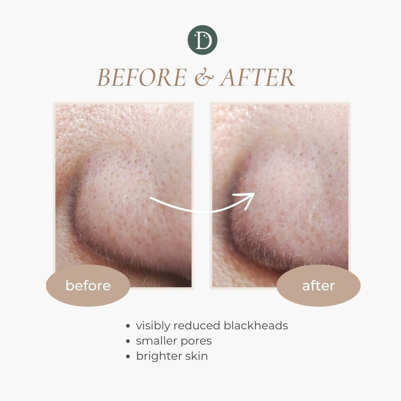 Deerieo Secret Garden exfoliating face mask before and after picture of skin with less blackheads, smaller pores and brighter skin.
